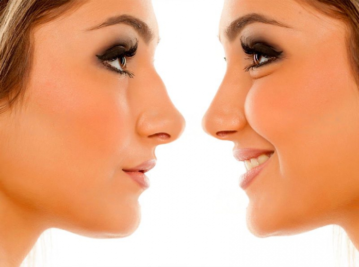 Rhinoplasty