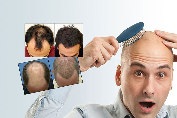 Hair Transplant